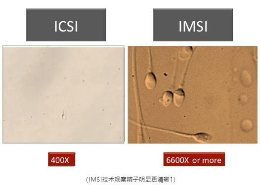 IMSI技术观察精子明显更清晰