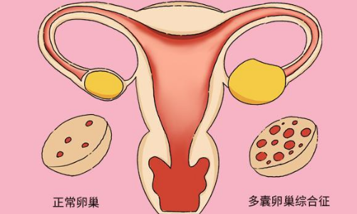 多囊卵巢患者易发腹水