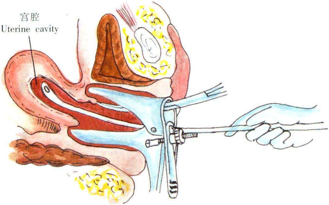 诊断性刮宫
