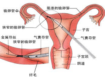 输卵管堵塞