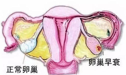 卵巢早衰无法自供卵生育