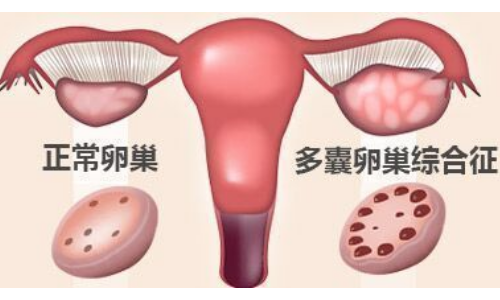 多囊卵巢示意图