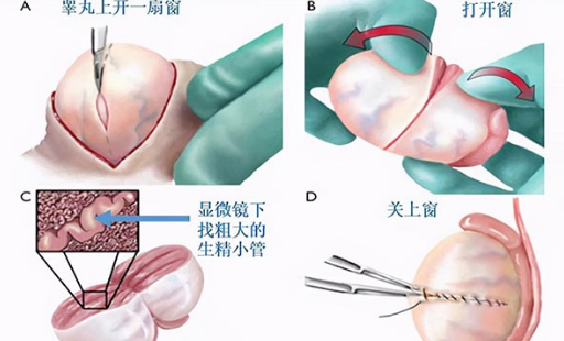 显微取精手术过程示意图