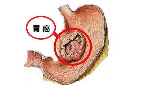 有发展成胃癌的可能