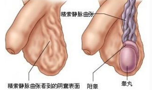 阴囊表面浮现出如虫状的血管分布