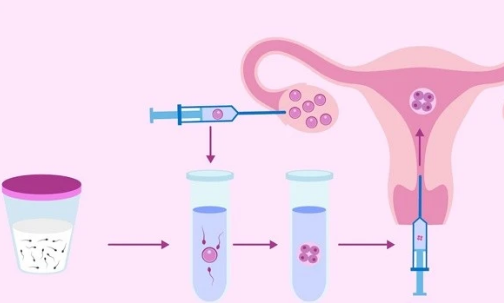 取精取卵后培育胚胎，再移植到子宫内