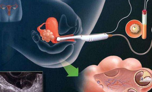 取卵手术示意图