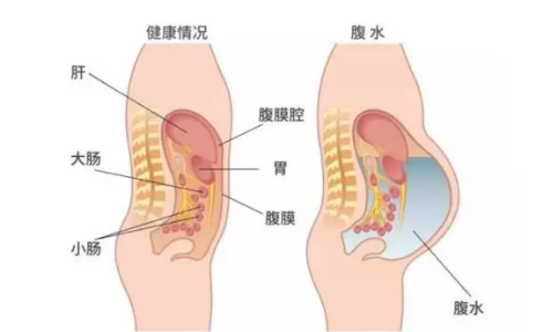 卵巢过度刺激表现症状之一