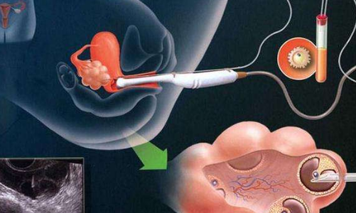 试管取卵手术示意图