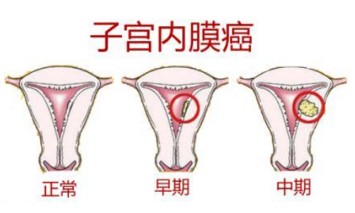 PCOS可能会发展为子宫内膜癌