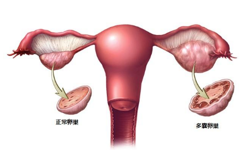 多囊卵巢综合征